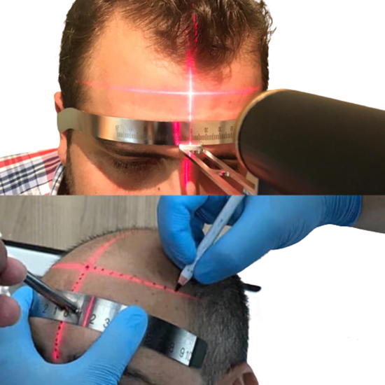 Saç ön hat işaretleme ve çizim lazeri -Hair line laser resmi